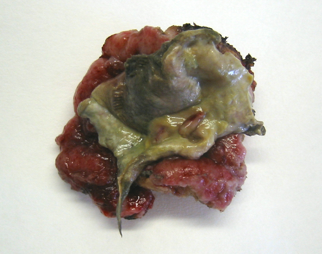 Figura 2.- - Reseccin segmentaria de pared gstrica con material de aspecto membranceo y necrtico superpuesto sobre una lesin ulcerosa.